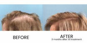 Exosomes vs PRP Treatment for Hair Loss