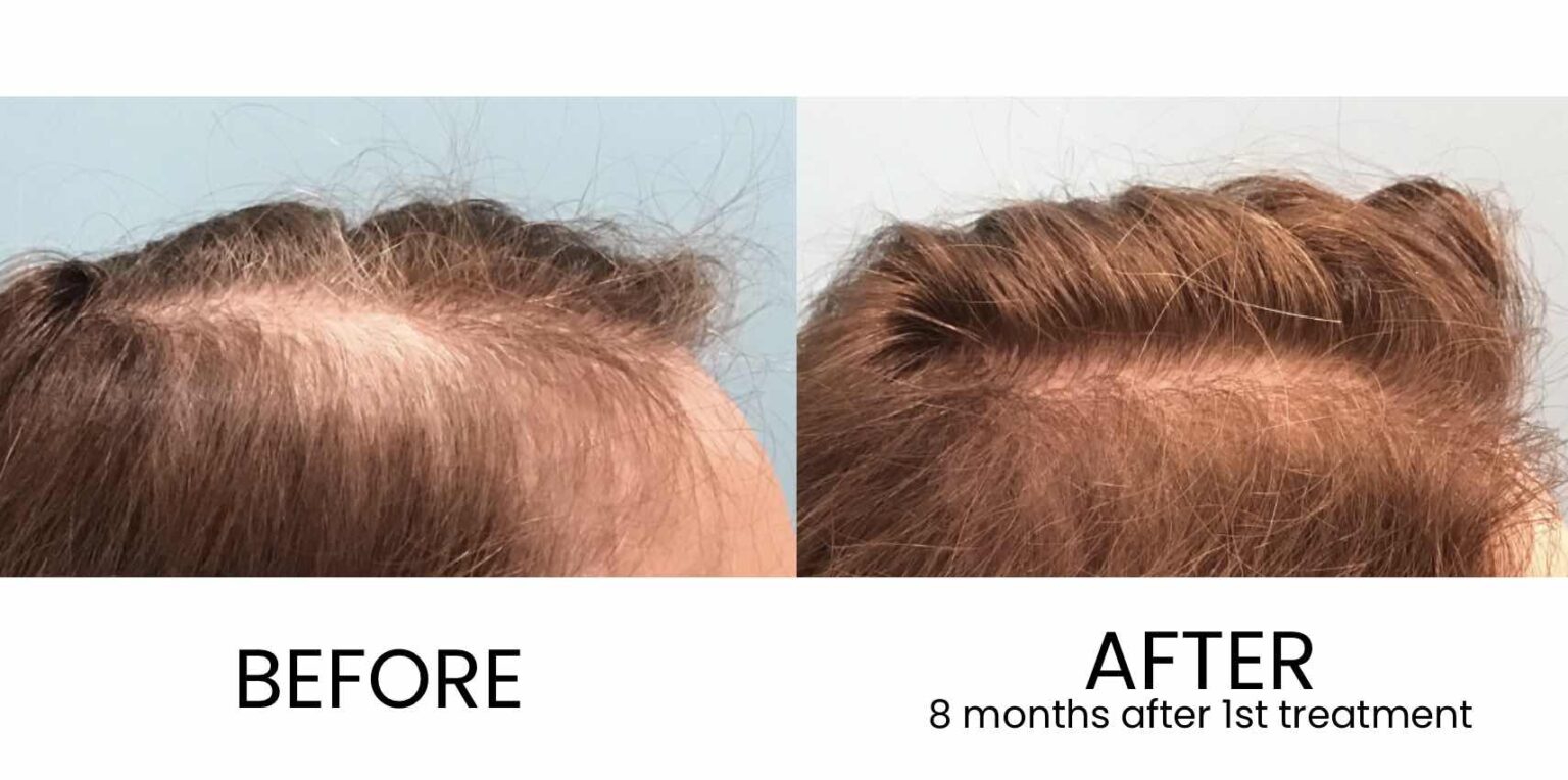 Exosome Hair  Restoration Taylor Plastic  Surgery 